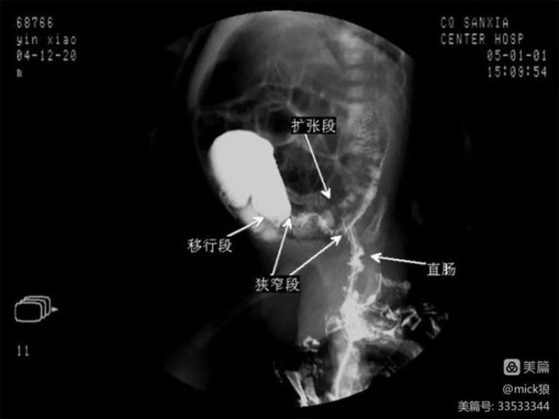 女子在家自行灌肠 确诊“水中毒”