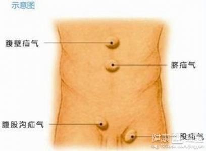 疝气手术变噩梦！睾丸竟被意外摘除，医患纠纷背后真相令人愤怒！